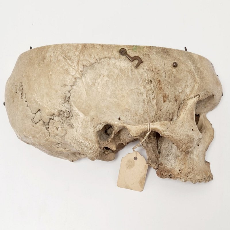 Partial Human Skull