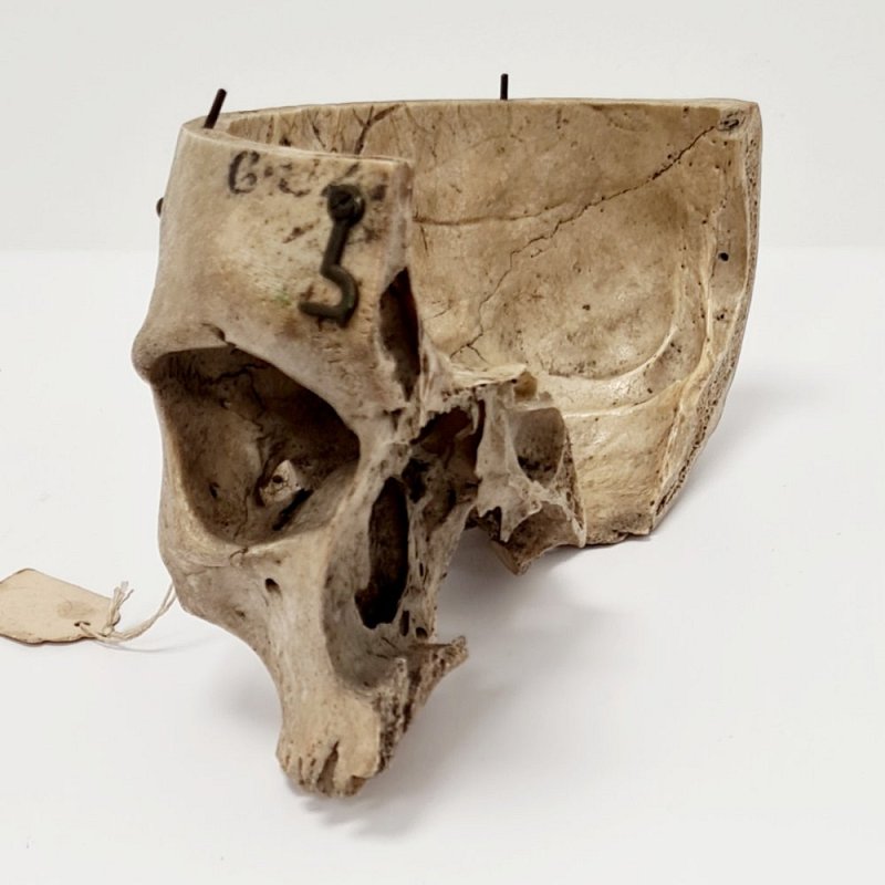 Partial Human Skull